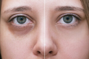 دلایل تیرگی زیر چشم چیست؟ راهکار های جلوگیری از تیرگی زیر چشم