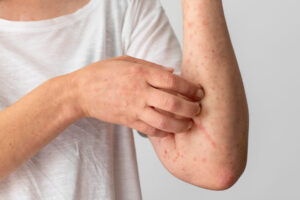 راهکارهای مقابله با آلرژی‌های پوستی