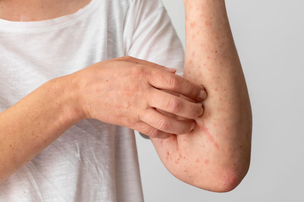 راهکارهای مقابله با آلرژی‌های پوستی