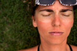 بهترین روش های درمان آفتاب سوختگی پس از سفر
